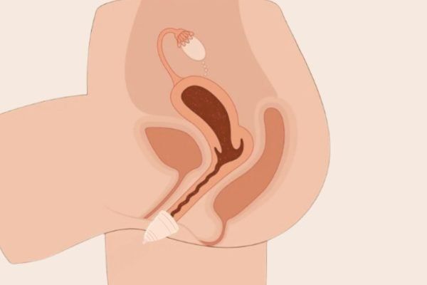 Copa menstrual. 10 cosas que debe saber 1 Copa menstrual 1 Gestor Web