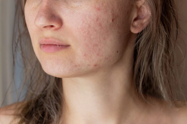 melasma Gestor Web